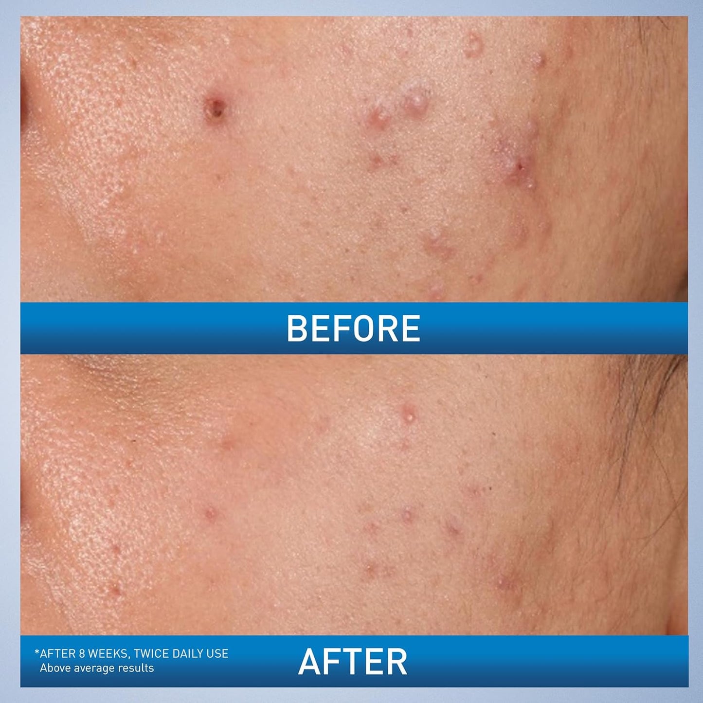 Acne Control Gel – 2% Salicylic Acid with AHA/BHA Complex
